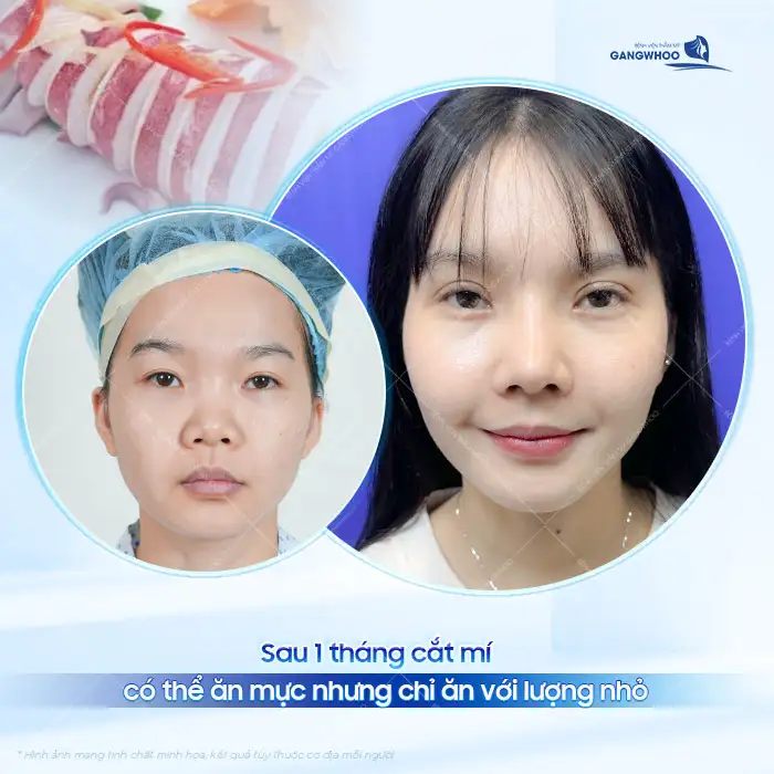 Sau cắt mí ăn mực được không? Sau bao lâu thì mới được ăn mực?