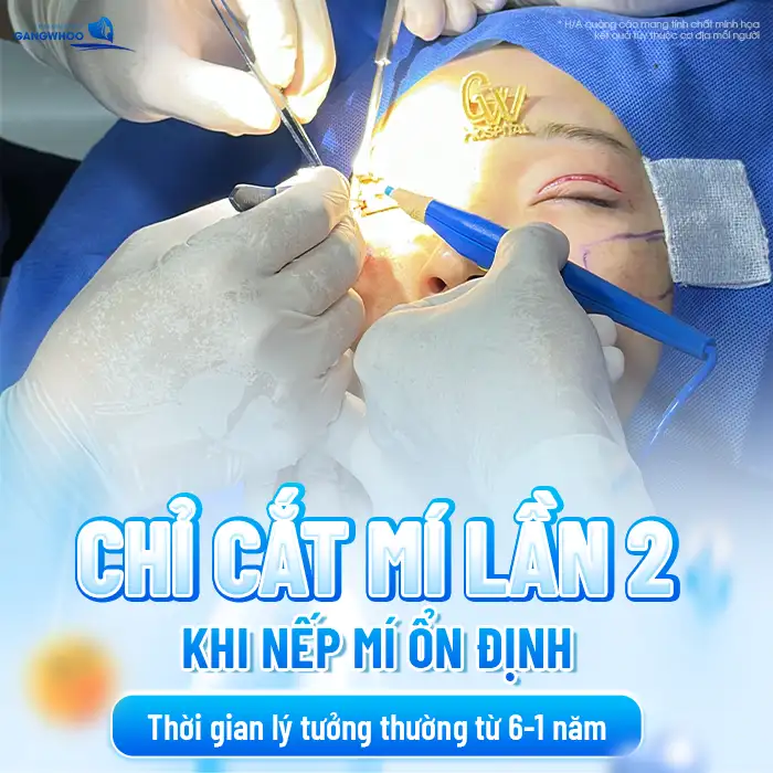 Cắt mí bao lâu thì cắt lại được? Trường hợp nào cần cắt lại