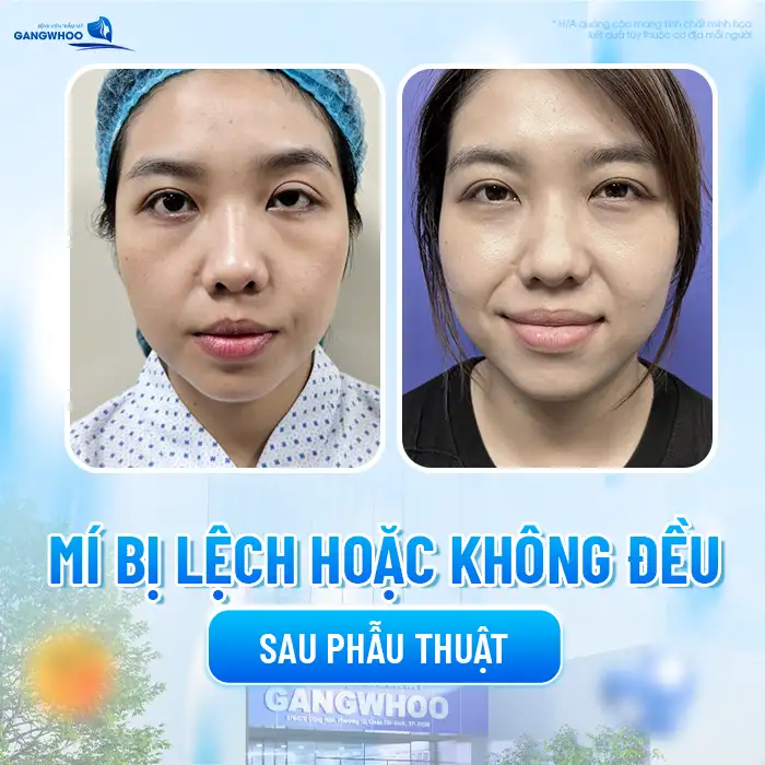 Cắt mí bao lâu thì cắt lại được? Trường hợp nào cần cắt lại