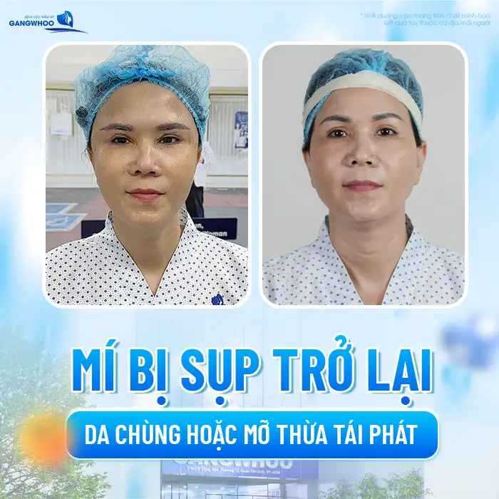 Cắt mí bao lâu thì cắt lại được? Trường hợp nào cần cắt lại
