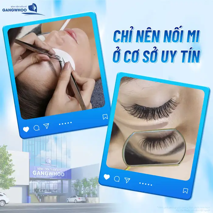 Cắt mí bao lâu thì được nối mi? Những lưu ý khi nối mi sau cắt mí