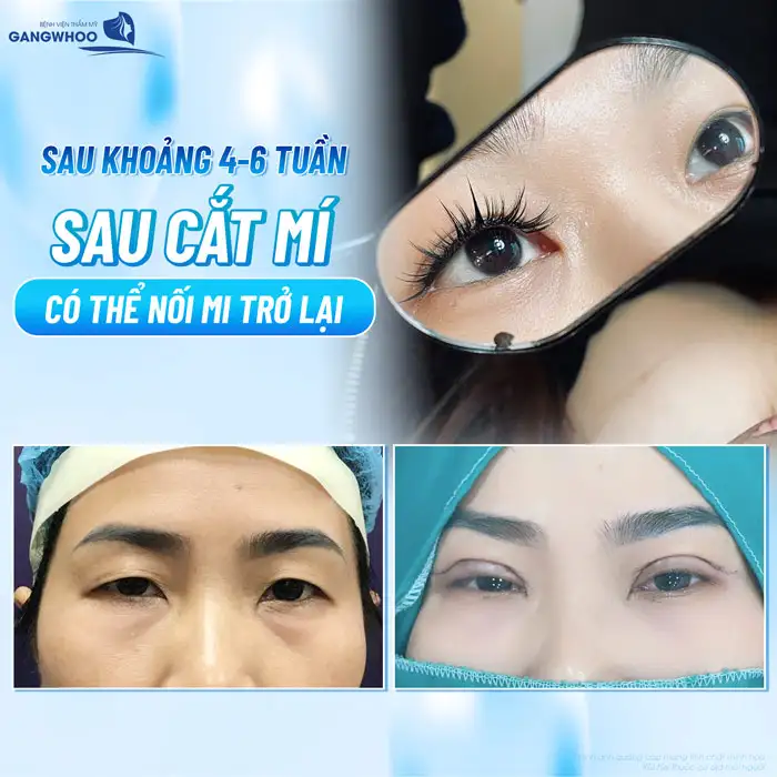 Cắt mí bao lâu thì được nối mi? Những lưu ý khi nối mi sau cắt mí
