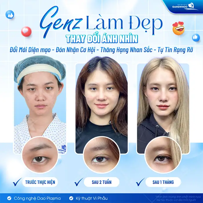 Cắt mí bao lâu thì hết sẹo? Cách giúp làm mờ sẹo nhanh sau cắt mí