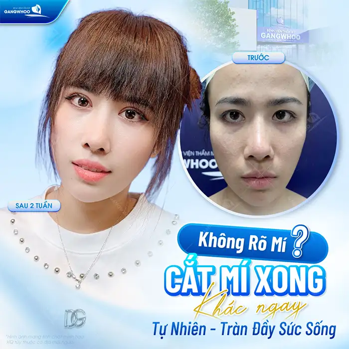 Cắt mí bao lâu thì hết sẹo? Cách giúp làm mờ sẹo nhanh sau cắt mí