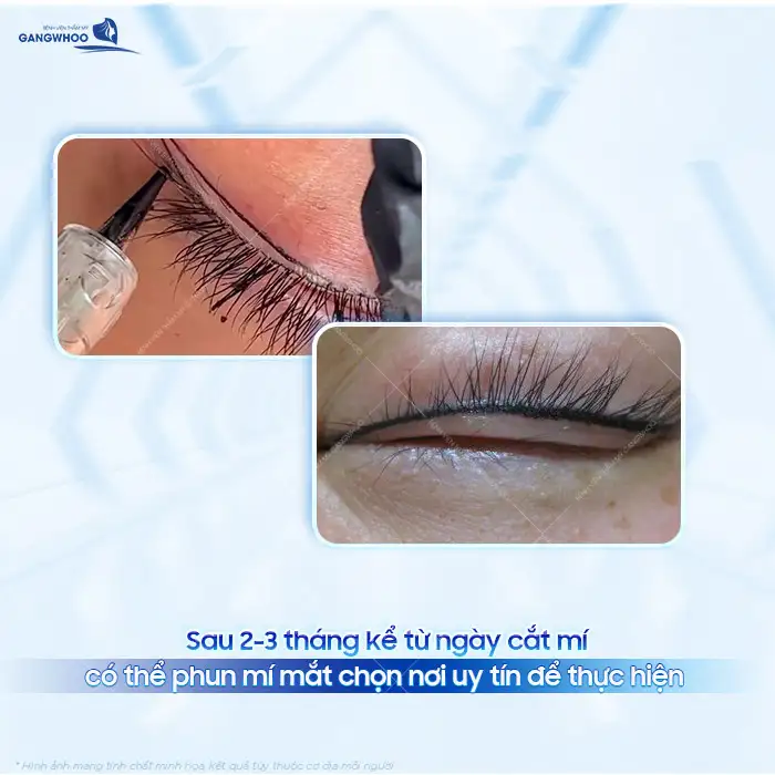 Cắt mí bao lâu thì phun mí được? Thời điểm nào thích hợp để phun mí