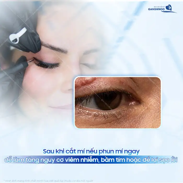 Cắt mí bao lâu thì phun mí được? Thời điểm nào thích hợp để phun mí