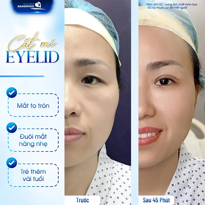 Cắt mí bao lâu thì sụp? Nguyên nhân dẫn đến sụp mí sau cắt mí?