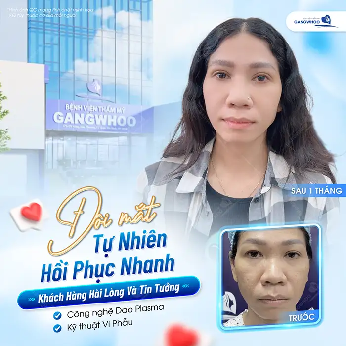 Cắt mí bao lâu thì sụp? Nguyên nhân dẫn đến sụp mí sau cắt mí?