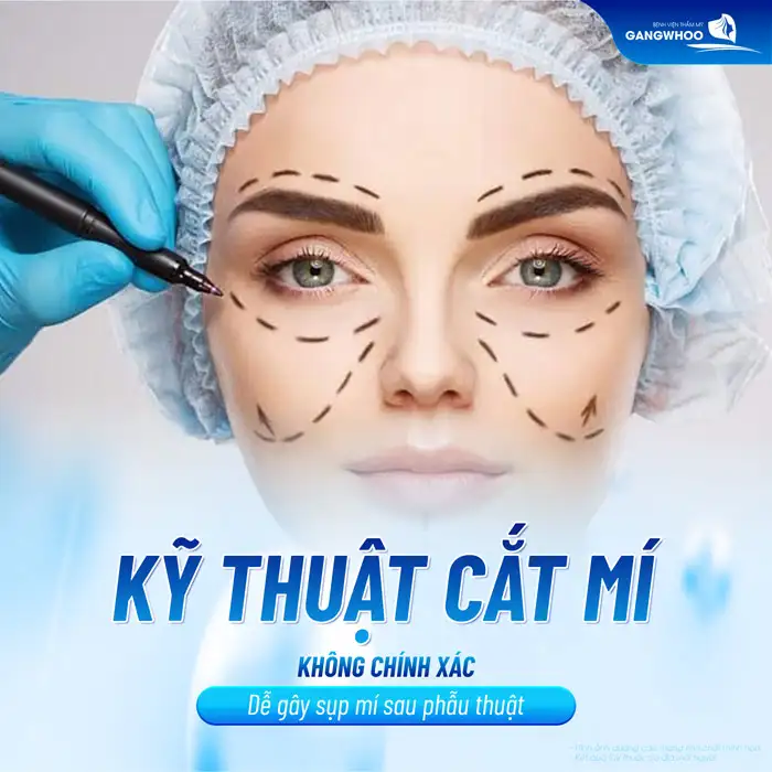 Cắt mí bao lâu thì sụp? Nguyên nhân dẫn đến sụp mí sau cắt mí?