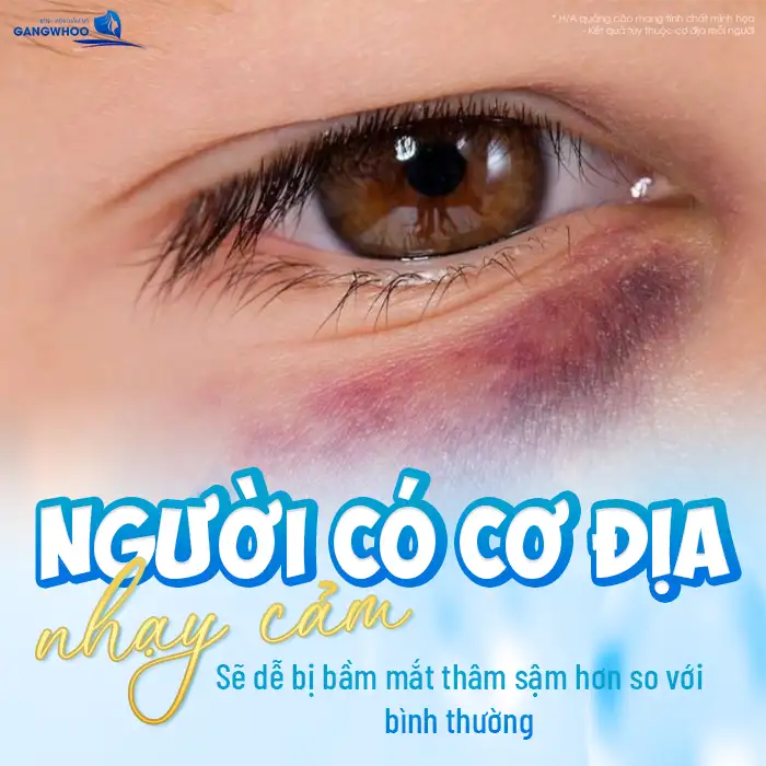 Cắt mí bị bầm phải làm sao? Cách xử lý khi cắt mí mắt bị bầm tím