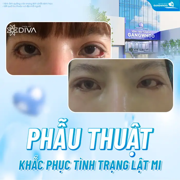 Nguyên nhân cắt mí bị lật mi là gì? Cách khắc phục ra sao?