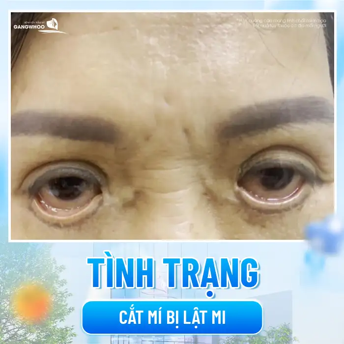 Nguyên nhân cắt mí bị lật mi là gì? Cách khắc phục ra sao?