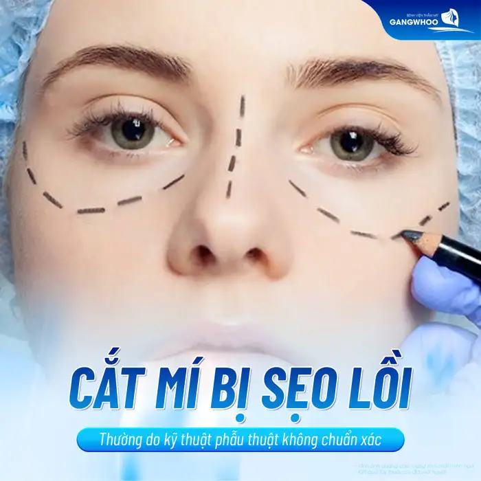 Cắt mí mắt bị sẹo lồi cần xử lý ra sao? Nguyên nhân do đâu?