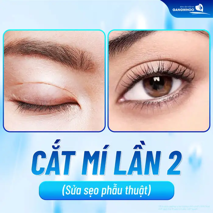 Cắt mí mắt bị sẹo lồi cần xử lý ra sao? Nguyên nhân do đâu?