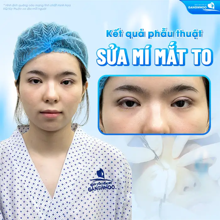 Cắt mí bị to quá có sửa được không? Nguyên nhân do đâu?