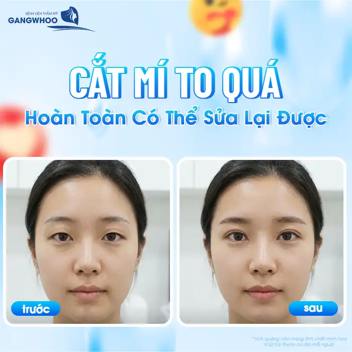 Cắt mí bị to quá có sửa được không? Nguyên nhân do đâu?