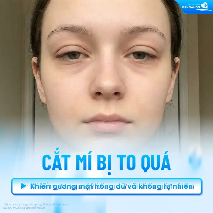Cắt mí bị to quá có sửa được không? Nguyên nhân do đâu?