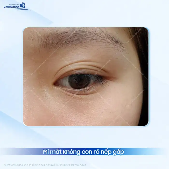 Tình trạng cắt mí bị tuột cơ nguyên nhân do đâu? Dấu hiệu và cách xử lý