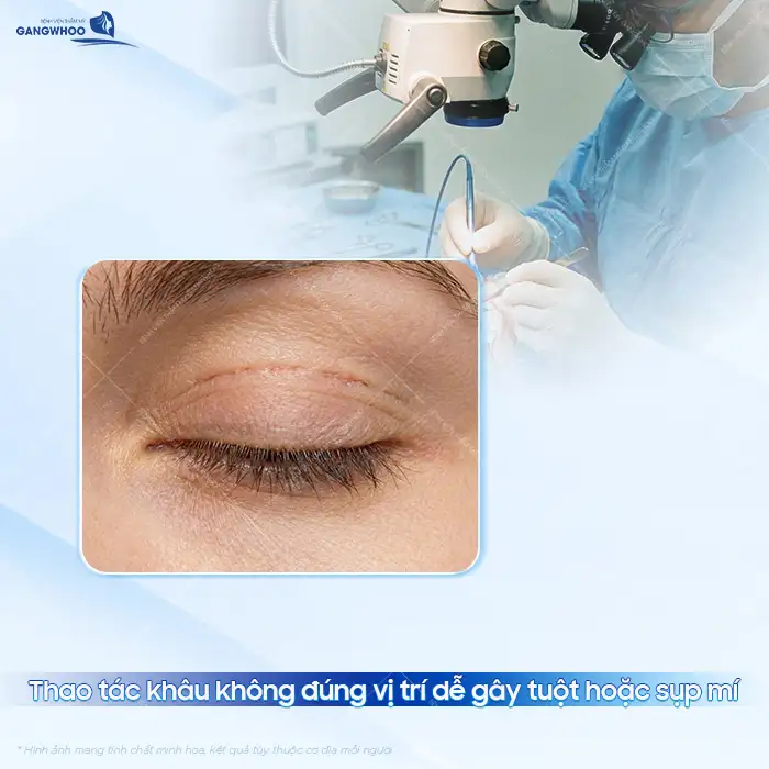 Tình trạng cắt mí bị tuột cơ nguyên nhân do đâu? Dấu hiệu và cách xử lý