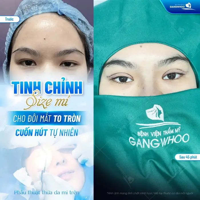 Có nên cắt mí cho mắt xếch không? Cắt mí cho mắt xếch có gây đau?