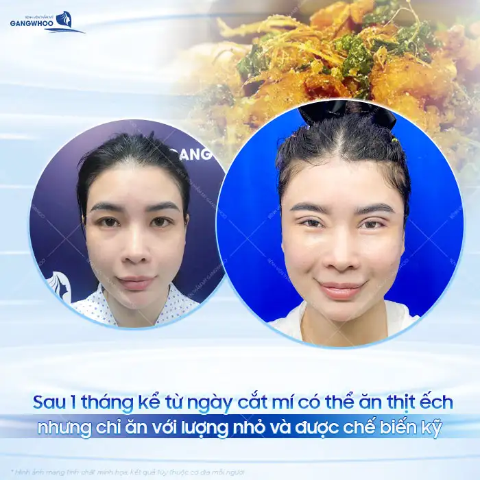 Sau cắt mí có được ăn ếch không? Có gây ảnh hưởng đến vết thương không?