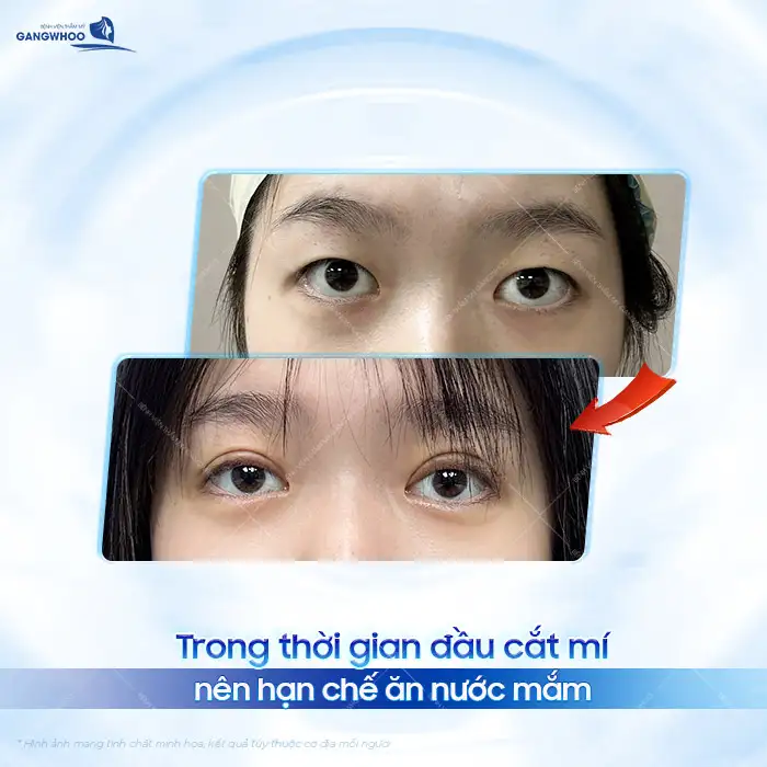 Sau cắt mí có được ăn nước mắm không? Nên kiêng trong bao lâu?