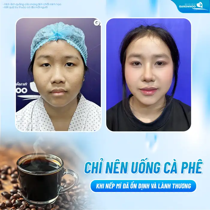 Cắt mí có được uống cà phê không? Nên kiêng uống cà phê bao lâu