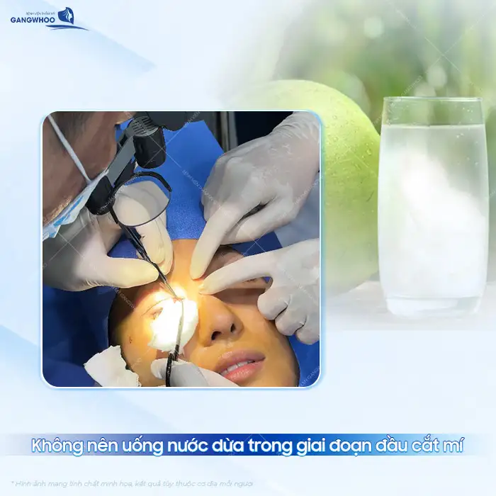 Sau cắt mí có được uống nước dừa không? Có ảnh hưởng gì không?