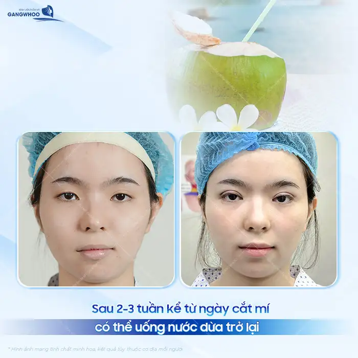 Sau cắt mí có được uống nước dừa không? Có ảnh hưởng gì không?
