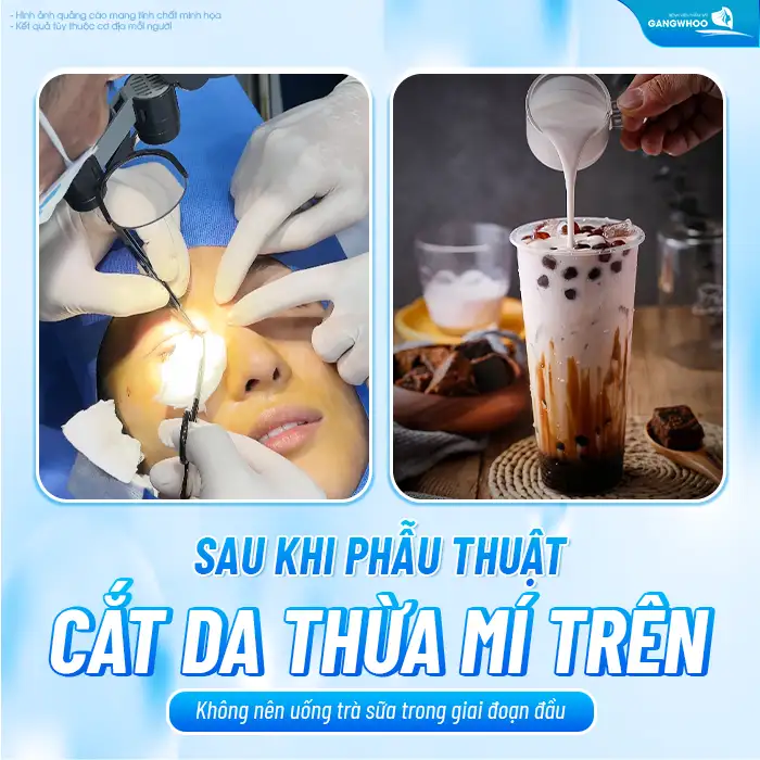 Cắt mí có được uống trà sữa không? Bao lâu thì được uống trà sữa