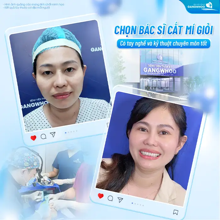 Cắt mí dưới bị hỏng nguyên nhân do đâu? Có khắc phục được không?