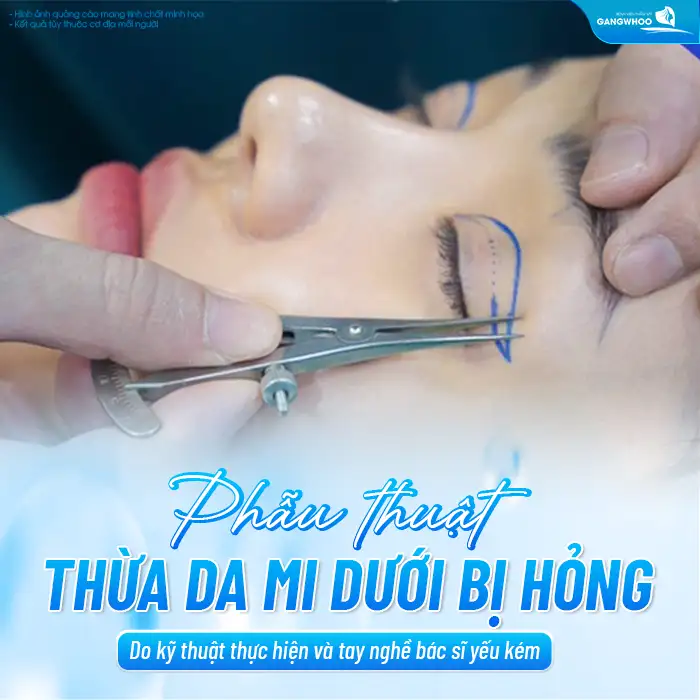 Cắt mí dưới bị hỏng nguyên nhân do đâu? Có khắc phục được không?