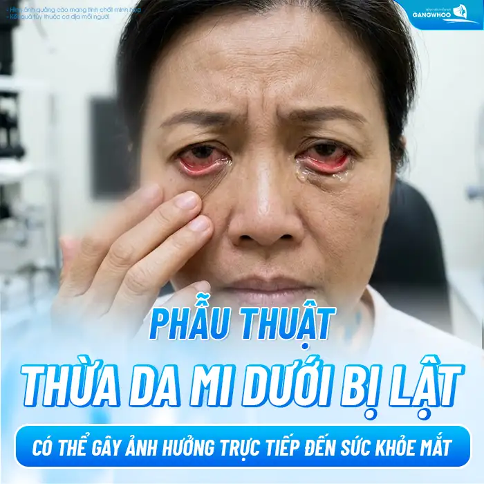 Cắt mí dưới bị lật phải xử lý ra sao? Cách khắc phục hiệu quả