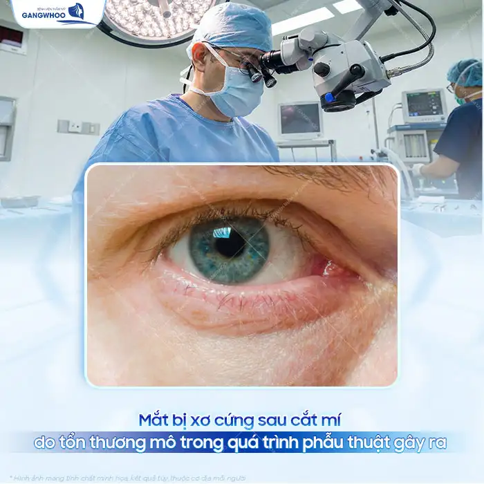 Nguyên nhân cắt mí dưới bị xơ cứng dưới da? Cách xử lý ra sao?