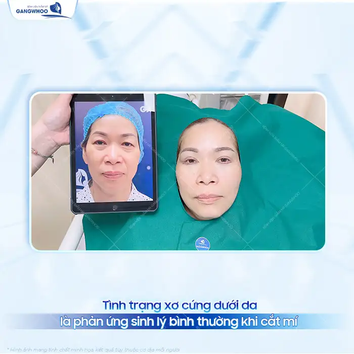 Nguyên nhân cắt mí dưới bị xơ cứng dưới da? Cách xử lý ra sao?