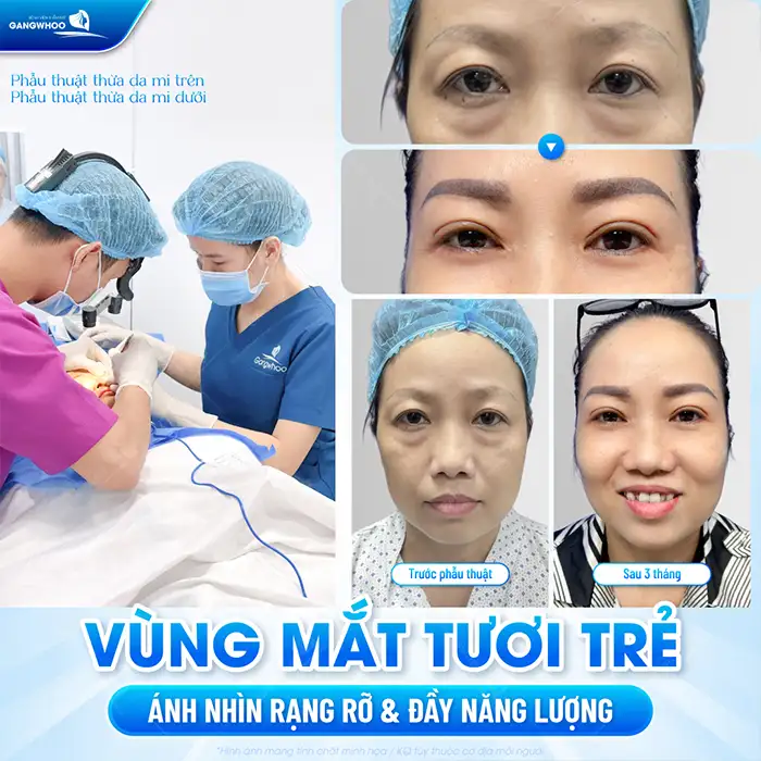 Cắt mí khi về già có sao không? Có xuất hiện biến chứng không?