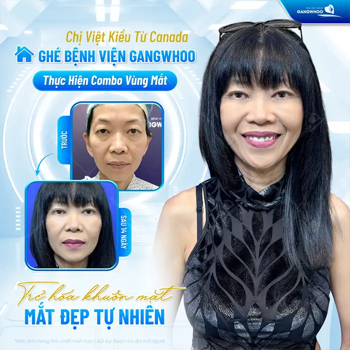 Cắt mí khi về già có sao không? Có xuất hiện biến chứng không?