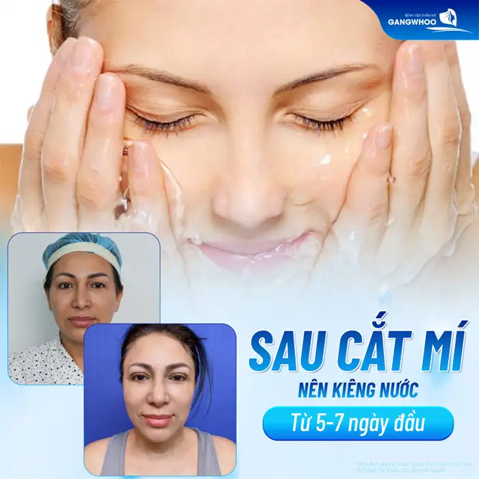 Cắt mí kiêng nước bao lâu? Vì sao cần phải kiêng nước sau cắt mí?