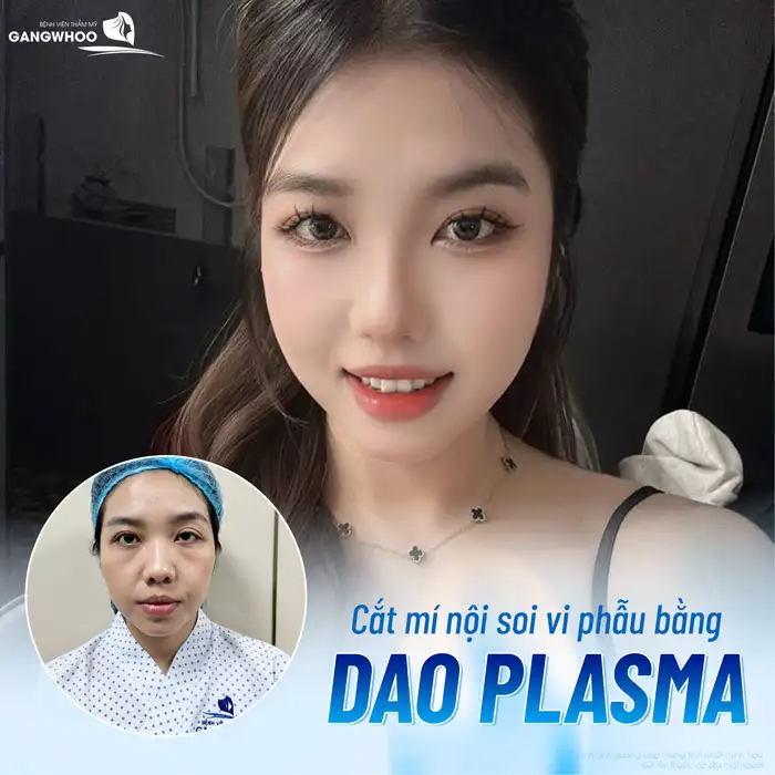 Cắt mí mắt 1 bên có được không? Nên lựa chọn phương pháp nào?