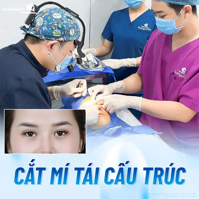 Cắt mí mắt 1 bên có được không? Nên lựa chọn phương pháp nào?