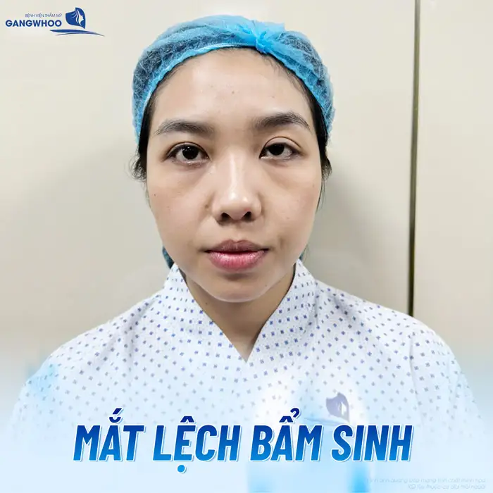 Cắt mí mắt 1 bên có được không? Nên lựa chọn phương pháp nào?