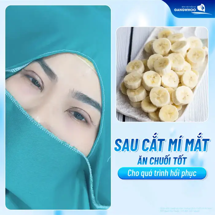 Sau phẫu thuật cắt mí mắt có được ăn chuối không?