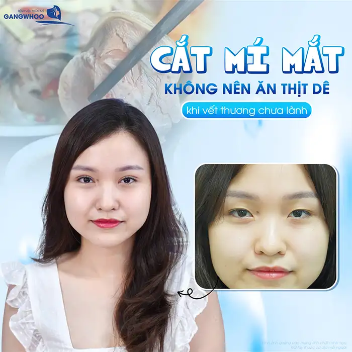 Cắt mí mắt ăn thịt dê được không? Nên kiêng thịt dê bao lâu?