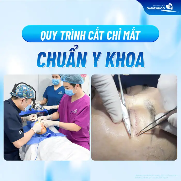 Cắt mí mắt bao lâu thì cắt chỉ? Quy trình cắt chỉ ra sao?