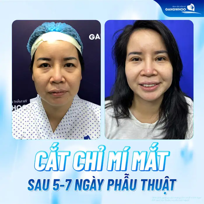 Cắt mí mắt bao lâu thì cắt chỉ? Quy trình cắt chỉ ra sao?