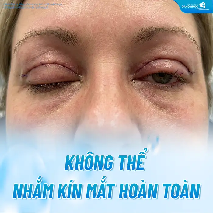 Vì sao cắt mí bị hở? Nguyên nhân và cách xử lý khi cắt mí bị hở