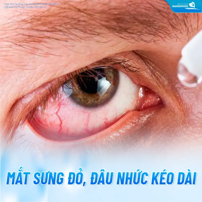 Cắt mí mắt bị ngứa nguyên nhân do đâu? Cách khắc phục ra sao?