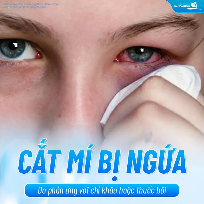 Cắt mí mắt bị ngứa nguyên nhân do đâu? Cách khắc phục ra sao?