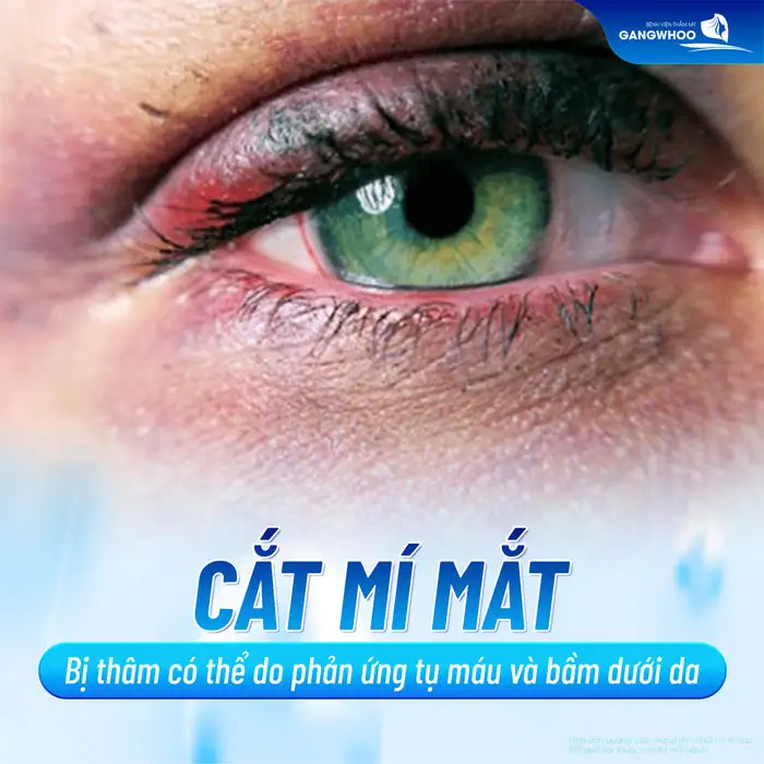 Cắt mí mắt bị thâm nguyên nhân do đâu? Cách xử lý ra sao?