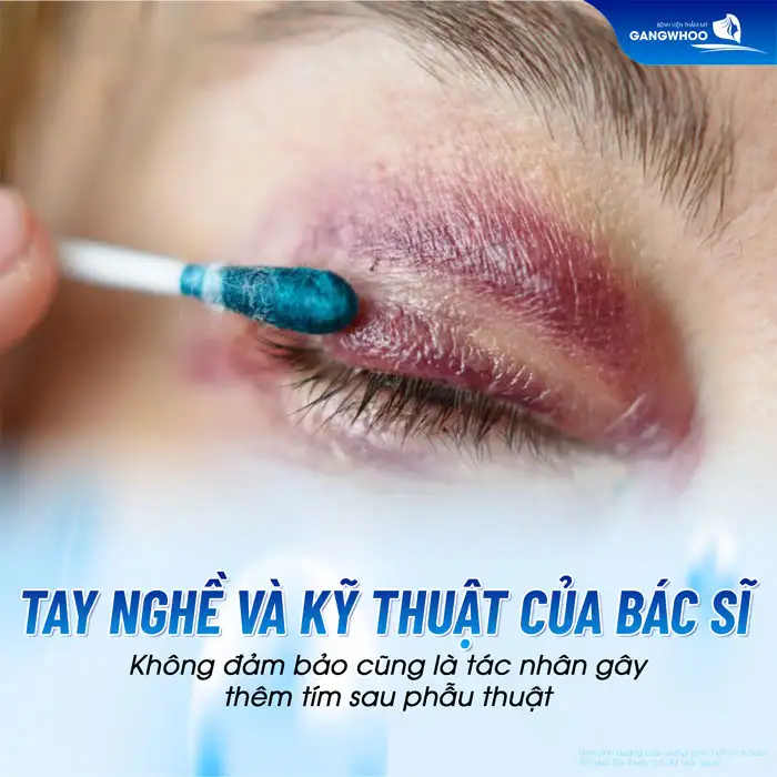 Cắt mí mắt bị thâm nguyên nhân do đâu? Cách xử lý ra sao?